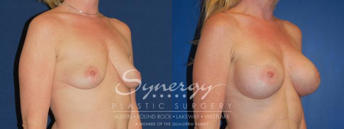 Before & After Breast Augmentation Case 221 View #3 View in Austin, TX