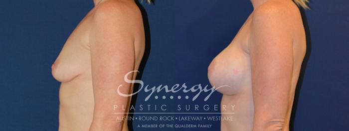 Before & After Breast Augmentation Case 221 View #6 View in Austin, TX