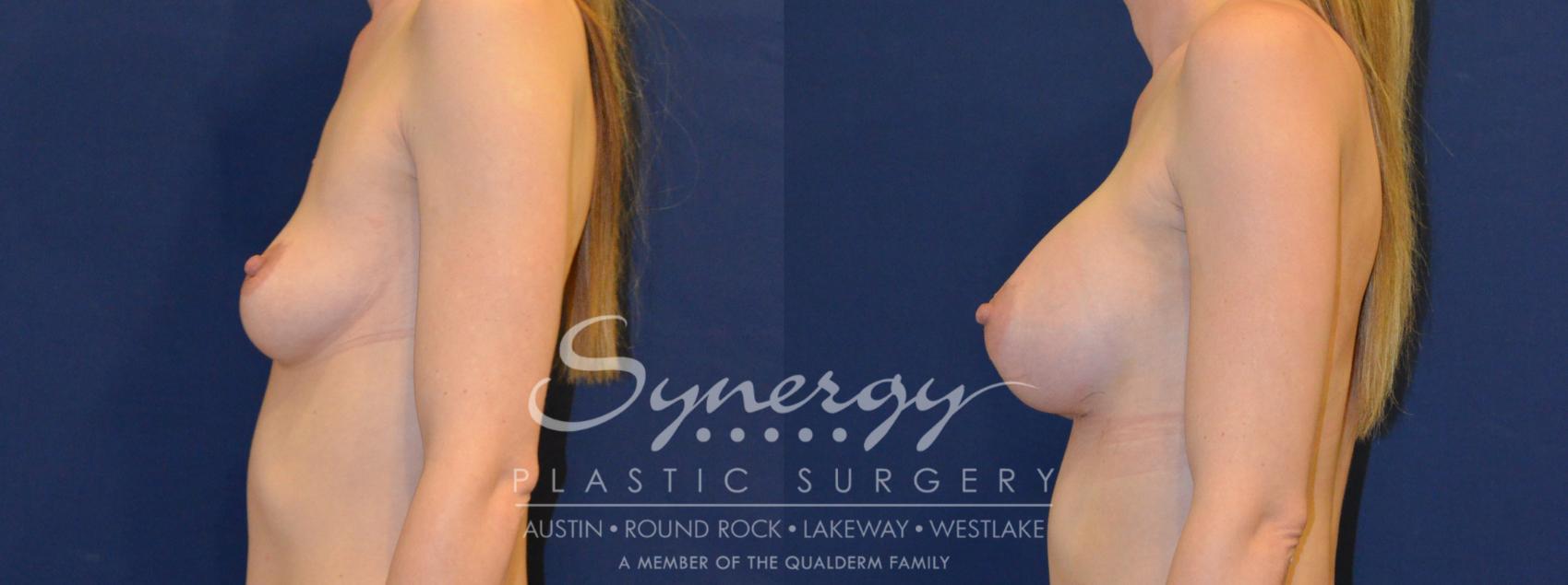 Before & After Breast Augmentation Case 222 View #1 View in Austin, TX