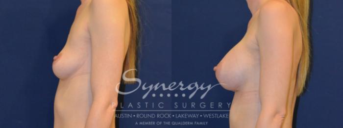 Before & After Breast Augmentation Case 222 View #1 View in Austin, TX