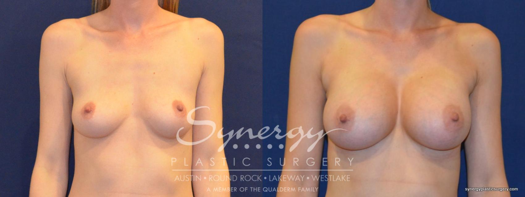 Before & After Breast Augmentation Case 222 View #2 View in Austin, TX