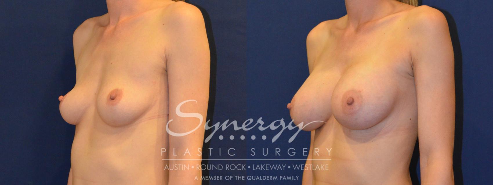 Before & After Breast Augmentation Case 222 View #3 View in Austin, TX