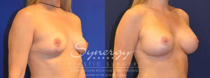 Before & After  Case 224 View #4 View in Austin, TX