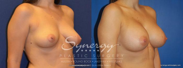 Before & After Breast Augmentation Case 228 View #4 View in Austin, TX