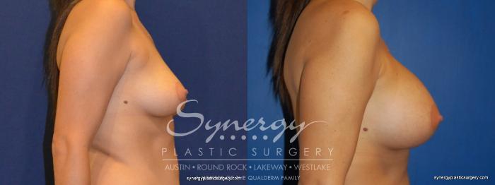 Before & After Breast Augmentation Case 228 View #5 View in Austin, TX