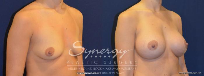 Before & After Breast Augmentation Case 235 View #1 View in Austin, TX