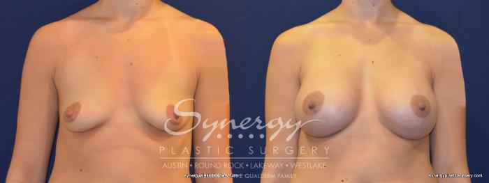 Before & After Breast Augmentation Case 235 View #2 View in Austin, TX