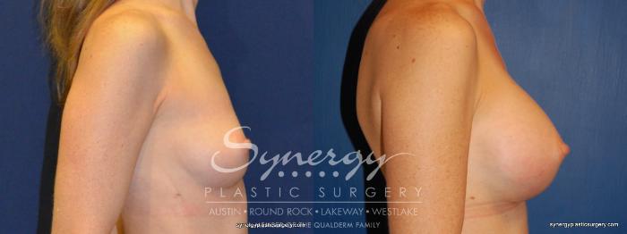 Before & After Breast Augmentation Case 245 View #1 View in Austin, TX