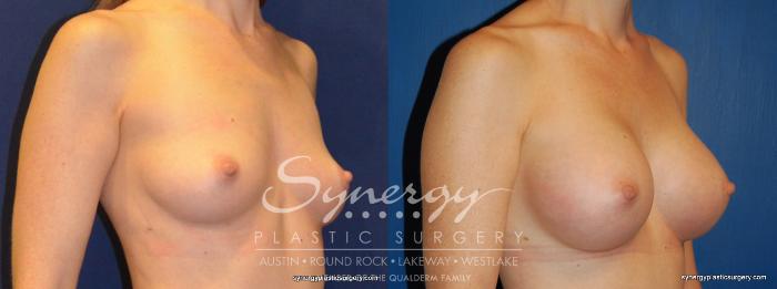 Before & After Breast Augmentation Case 245 View #3 View in Austin, TX