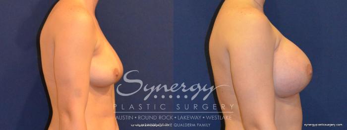 Before & After Breast Augmentation Case 249 View #2 View in Austin, TX