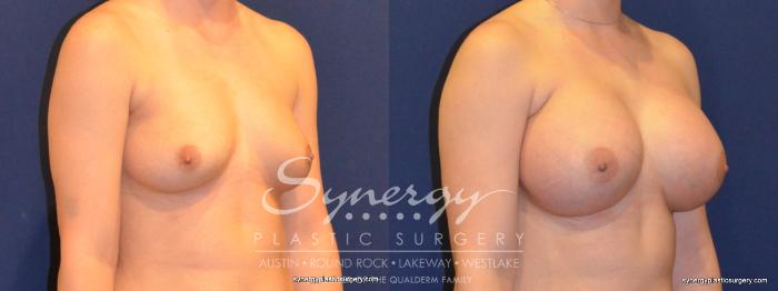 Before & After Breast Augmentation Case 249 View #3 View in Austin, TX
