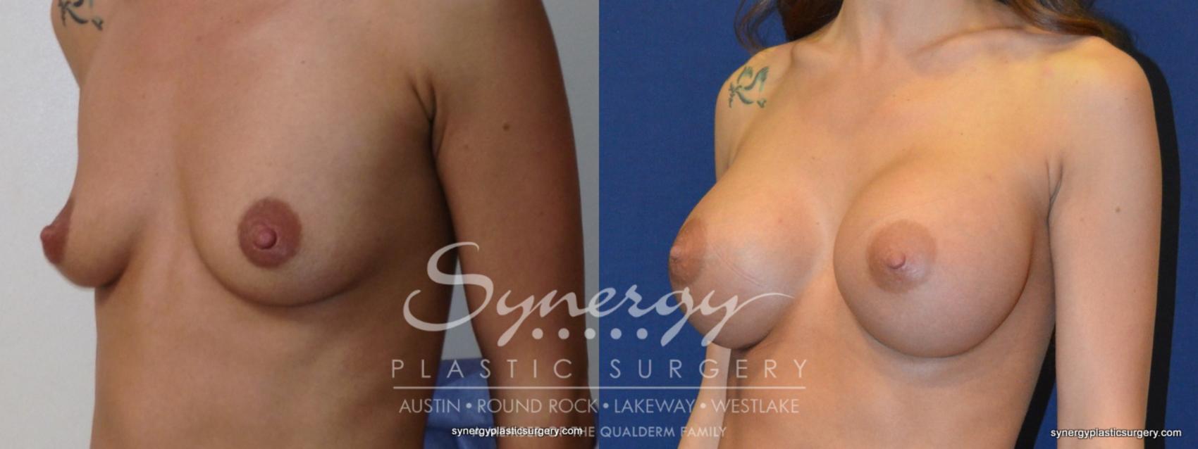 Before & After Breast Augmentation Case 250 View #1 View in Austin, TX