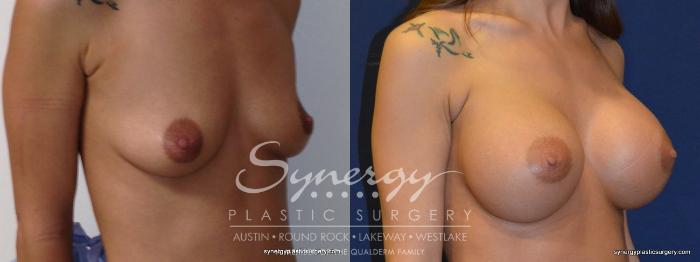 Before & After Breast Augmentation Case 250 View #4 View in Austin, TX