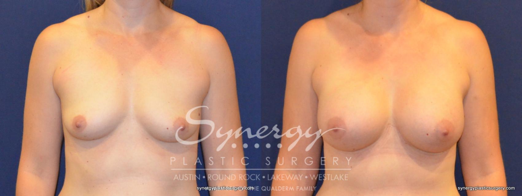 Before & After Breast Augmentation Case 255 View #1 View in Austin, TX