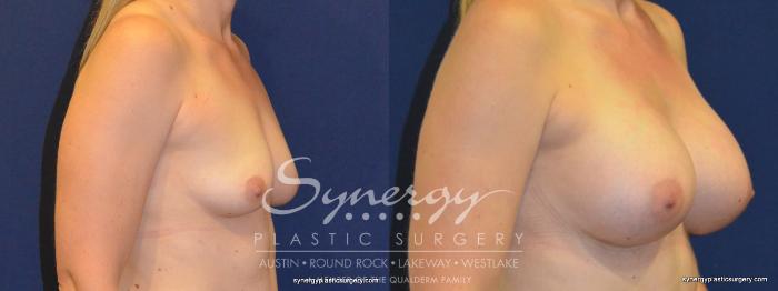 Before & After Breast Augmentation Case 255 View #2 View in Austin, TX
