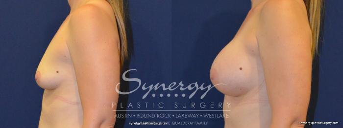 Before & After Breast Augmentation Case 255 View #4 View in Austin, TX