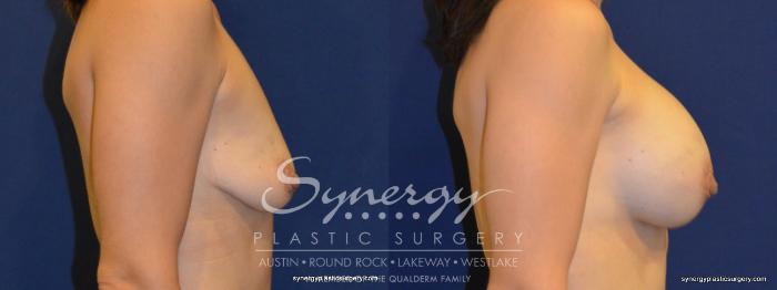 Before & After Breast Augmentation Case 259 View #3 View in Austin, TX