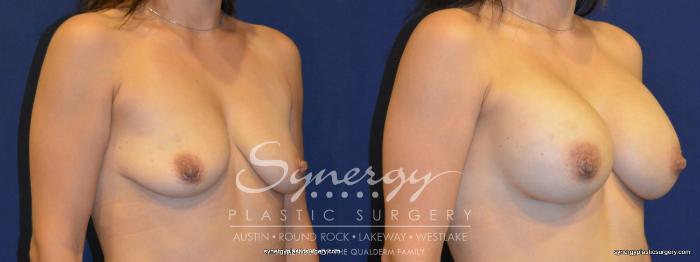 Before & After Breast Augmentation Case 259 View #4 View in Austin, TX
