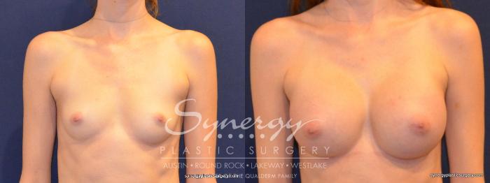 Before & After Breast Augmentation Case 260 View #3 View in Austin, TX