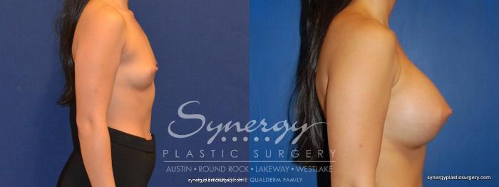 Before & After Breast Augmentation Case 263 View #3 View in Austin, TX
