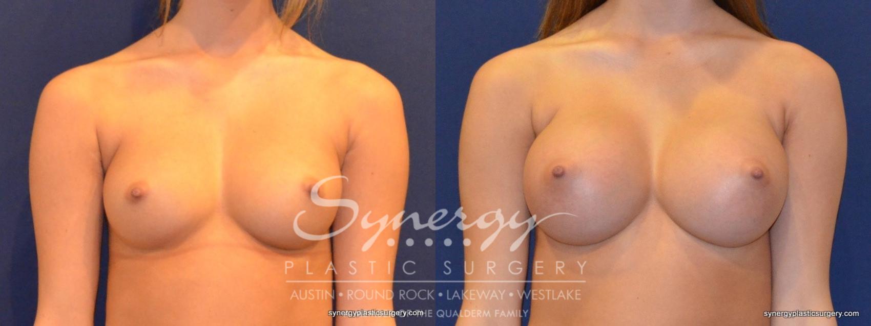 Before & After Breast Augmentation Case 264 View #1 View in Austin, TX