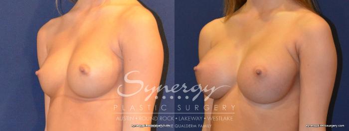 Before & After Breast Augmentation Case 264 View #2 View in Austin, TX