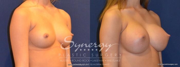 Before & After Breast Augmentation Case 264 View #3 View in Austin, TX