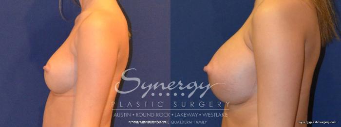 Before & After Breast Augmentation Case 264 View #4 View in Austin, TX