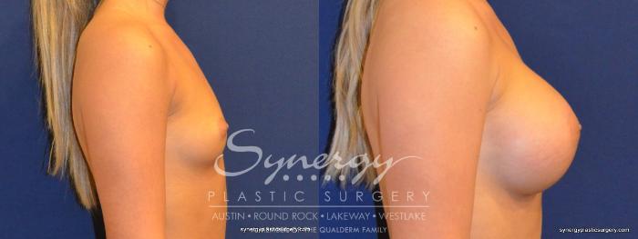 Before & After Breast Augmentation Case 265 View #2 View in Austin, TX