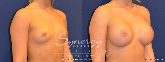 Before & After Breast Augmentation Case 265 View #3 View in Austin, TX