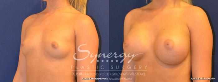 Before & After Breast Augmentation Case 265 View #4 View in Austin, TX