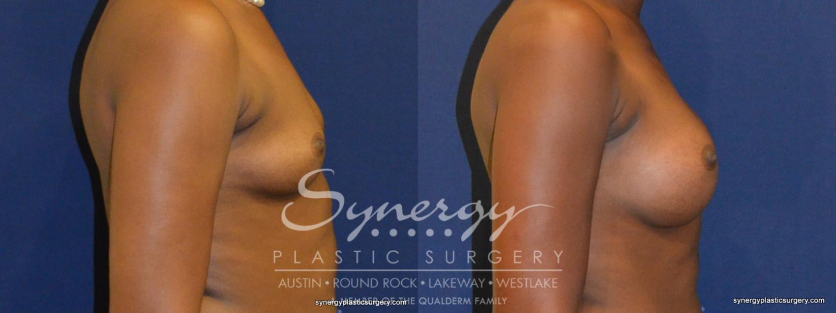 Before & After Breast Augmentation Case 267 View #1 View in Austin, TX