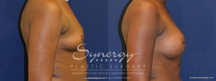 Before & After Breast Augmentation Case 267 View #1 View in Austin, TX