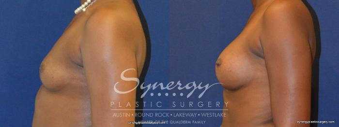 Before & After Breast Augmentation Case 267 View #3 View in Austin, TX