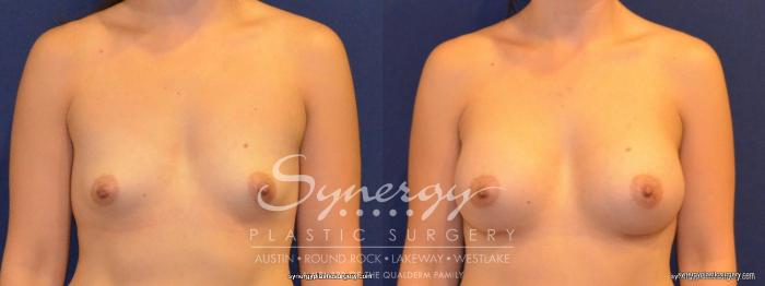 Before & After Breast Augmentation Case 269 View #2 View in Austin, TX
