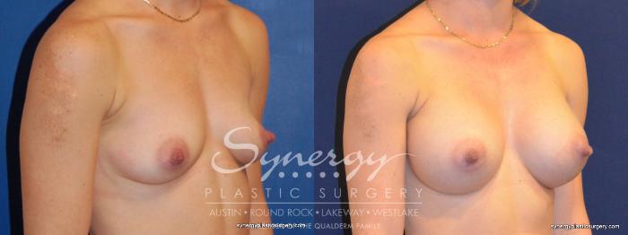 Before & After Breast Augmentation Case 270 View #4 View in Austin, TX