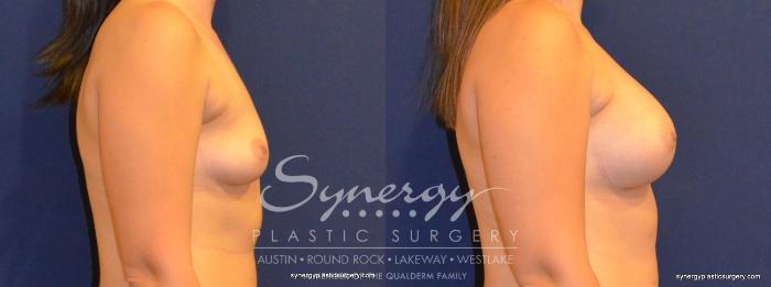 Before & After Breast Augmentation Case 277 View #3 View in Austin, TX