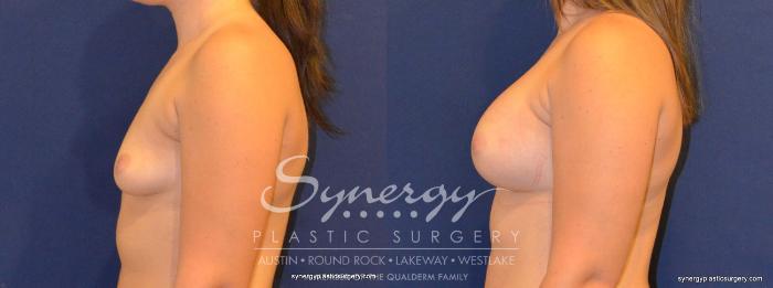 Before & After Breast Augmentation Case 277 View #5 View in Austin, TX