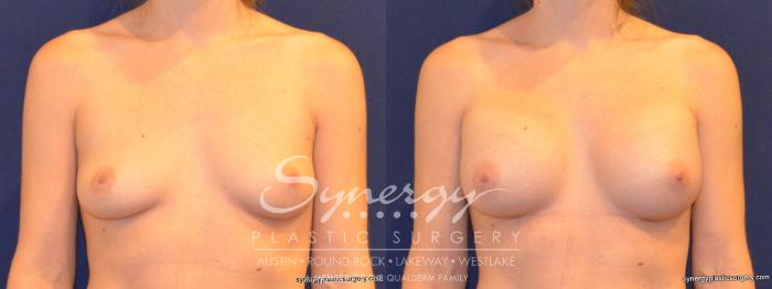 Before & After Breast Augmentation Case 281 View #2 View in Austin, TX