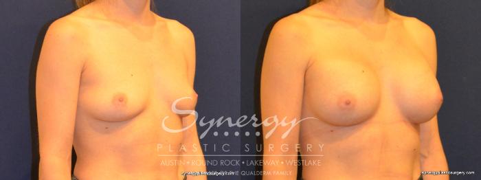Before & After Breast Augmentation Case 281 View #4 View in Austin, TX