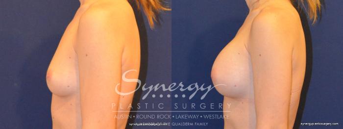 Before & After Breast Augmentation Case 281 View #5 View in Austin, TX