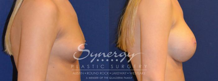 Before & After Breast Augmentation Case 285 View #3 View in Austin, TX
