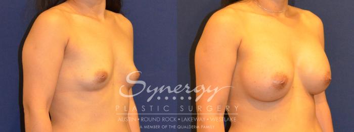 Before & After Breast Augmentation Case 293 View #3 View in Austin, TX