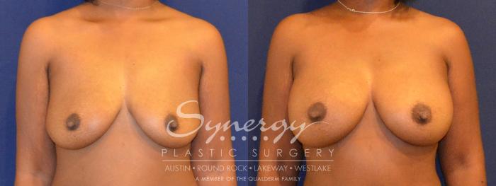 Before & After Breast Augmentation Case 298 View #1 View in Austin, TX