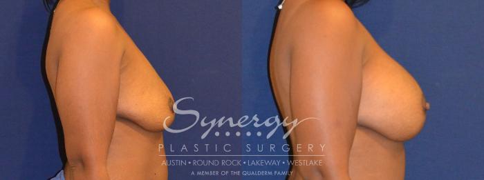 Before & After Breast Augmentation Case 298 View #2 View in Austin, TX
