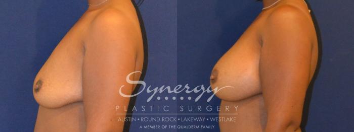 Before & After Breast Augmentation Case 298 View #4 View in Austin, TX