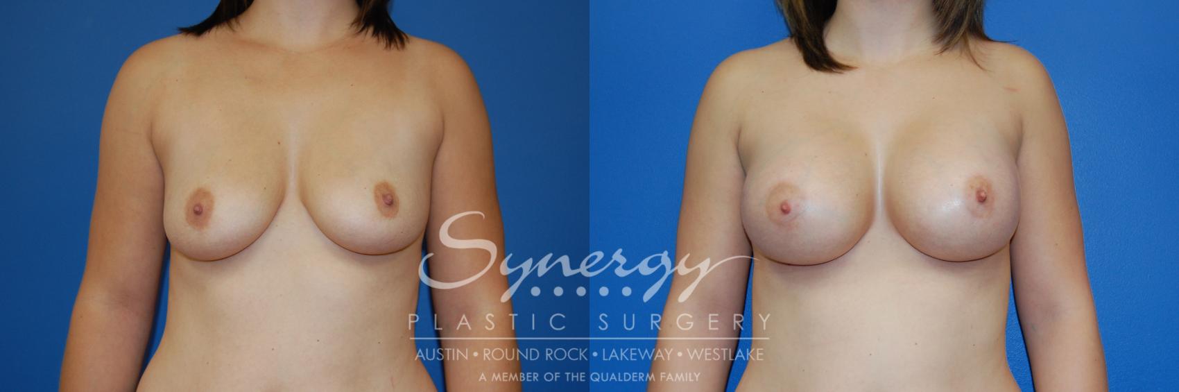Before & After Breast Augmentation Case 3 View #1 View in Austin, TX