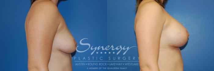 Before & After Breast Augmentation Case 3 View #4 View in Austin, TX