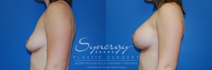 Before & After Breast Augmentation Case 3 View #5 View in Austin, TX
