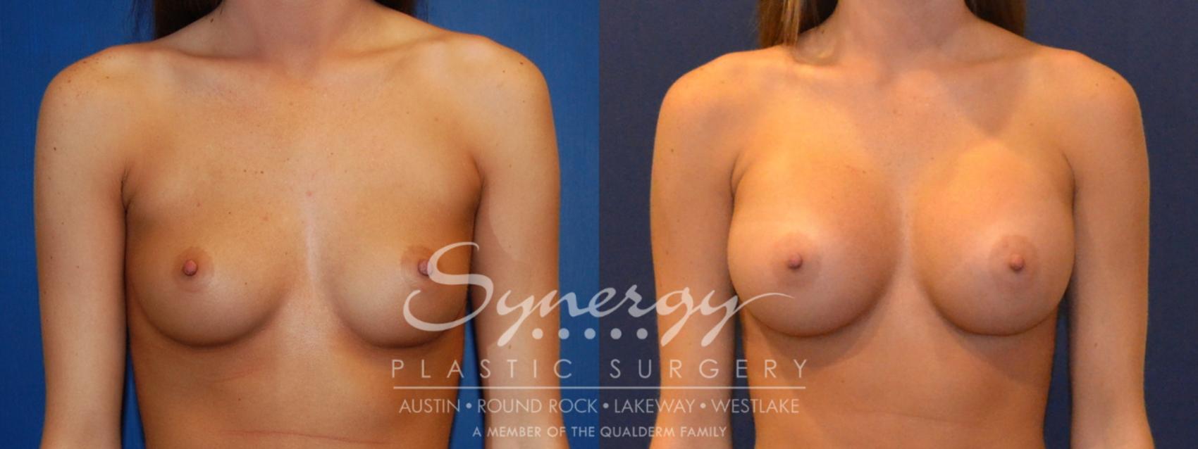 Before & After Breast Augmentation Case 304 View #1 View in Austin, TX